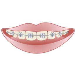 岡山市北区東古松の歯医者「すまいるフレンド歯科」 メタルブラケット