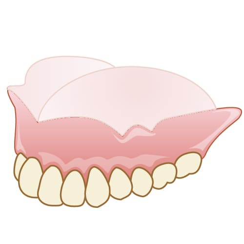 岡山市北区東古松の歯医者「すまいるフレンド歯科」 コンフォート加工の入れ歯の特徴