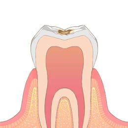 岡山市北区東古松の歯医者「すまいるフレンド歯科」 C1（エナメル質の虫歯