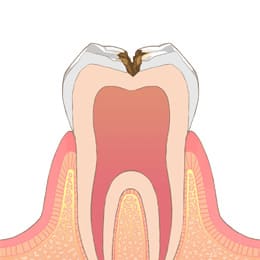 岡山市北区東古松の歯医者「すまいるフレンド歯科」 C2（象牙質の虫歯）