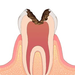 岡山市北区東古松の歯医者「すまいるフレンド歯科」 C3（神経まで進行した虫歯