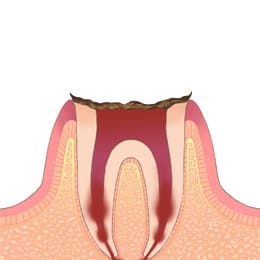 岡山市北区東古松の歯医者「すまいるフレンド歯科」 C4（歯の根まで進行した虫歯）