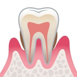 岡山市北区東古松の歯医者「すまいるフレンド歯科」 中度歯周病