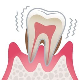 岡山市北区東古松の歯医者「すまいるフレンド歯科」 重度歯周病